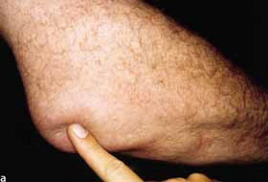 Bursitis